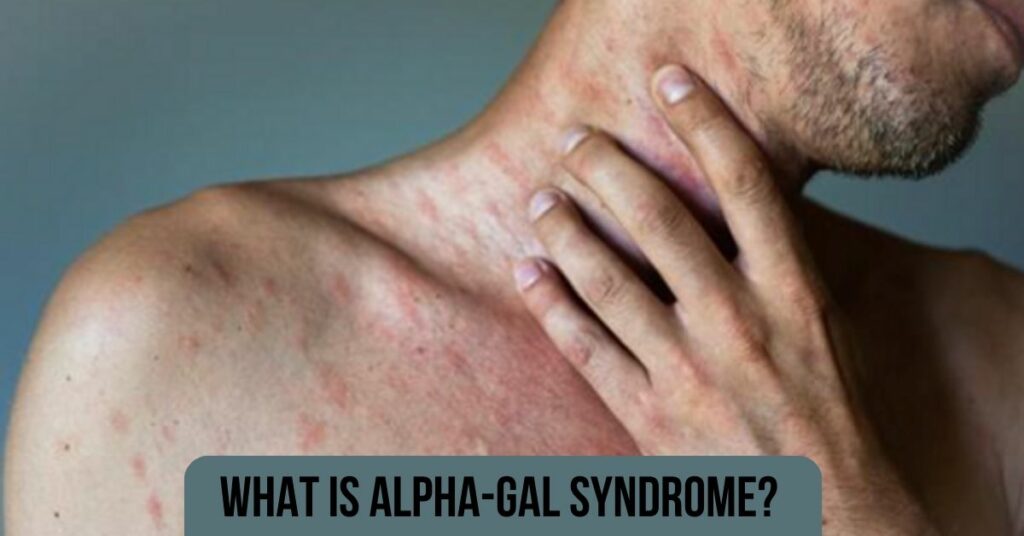 What is Alpha-gal syndrome?